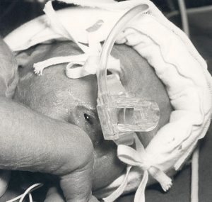 The first prototype in use on a baby, born in week 25 and weighing 660 gram. Picture from 1987.