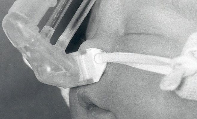 First commercial CPAP system produced by EME in 1990.